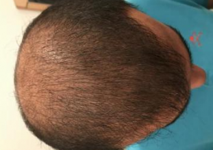 4000-grafts-hair-transplant-result-10