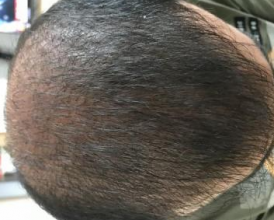 4000-grafts-hair-transplant-result-11