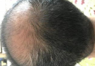 4000-grafts-hair-transplant-result-12