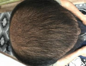 4000-grafts-hair-transplant-result-13