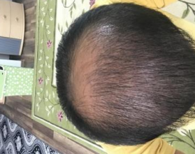 4000-grafts-hair-transplant-result-14