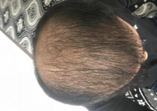 4000-grafts-hair-transplant-result-15