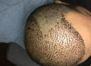 4000-grafts-hair-transplant-result-2