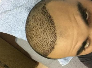 4000-grafts-hair-transplant-result-3