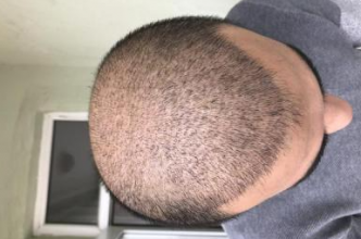 4000-grafts-hair-transplant-result-4