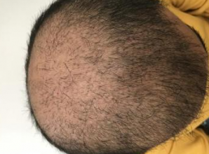 4000-grafts-hair-transplant-result-7