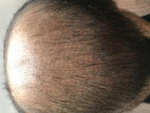 4000-grafts-hair-transplant-result-8