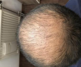 4000-grafts-hair-transplant-result-9
