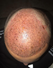 hair-transplant-izmir