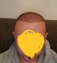 hair-transplant-izmir
