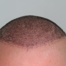 hair-transplant-izmir