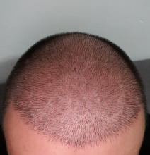 hair-transplant-izmir