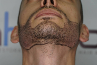 beard-transplant