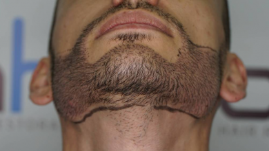 beard-transplant