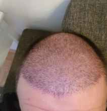 hair-transplant-izmir