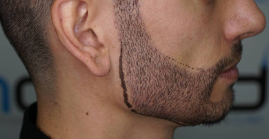 beard-transplant