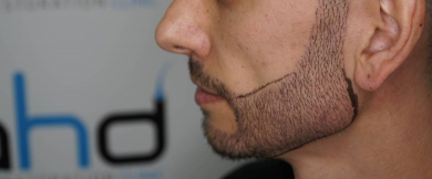 beard-transplant