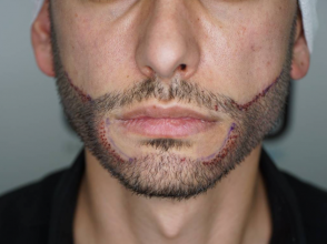 beard-transplant