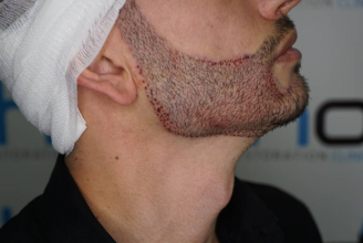beard-transplant