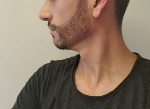 beard-transplant