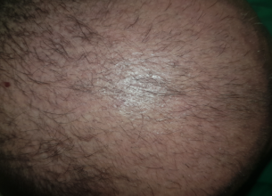 hair-transplant-izmir