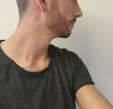 beard-transplant