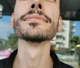 beard-transplant