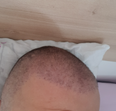 hair-transplant-izmir