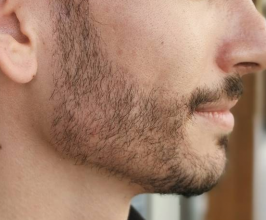beard-transplant