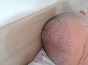 hair-transplant-izmir