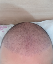 hair-transplant-izmir