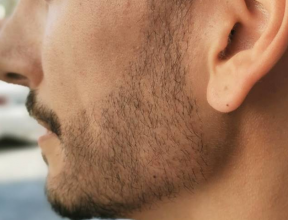 beard-transplant