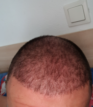 hair-transplant-izmir