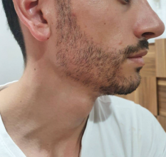 beard-transplant