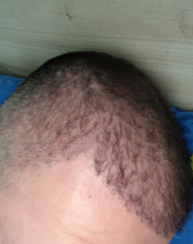 hair-transplant-izmir