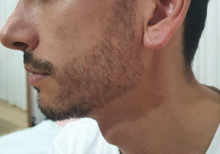beard-transplant