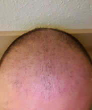 hair-transplant-izmir