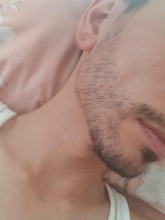 beard-transplant