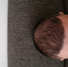 hair-transplant-izmir