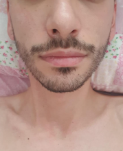 beard-transplant