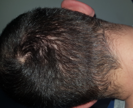 hair-transplant-izmir