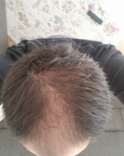 hair-transplant-izmir