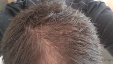 hair-transplant-izmir