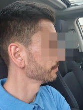 beard-transplant