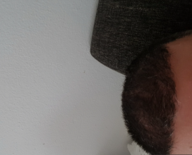 hair-transplant-izmir