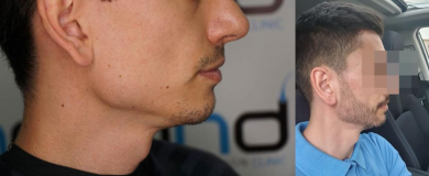 beard-transplant