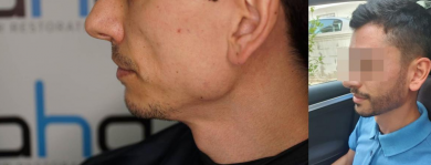 beard-transplant