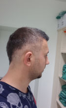 hair-transplant-izmir