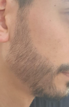 beard-transplant