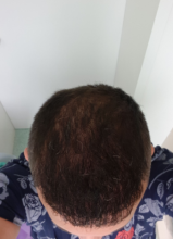 hair-transplant-izmir